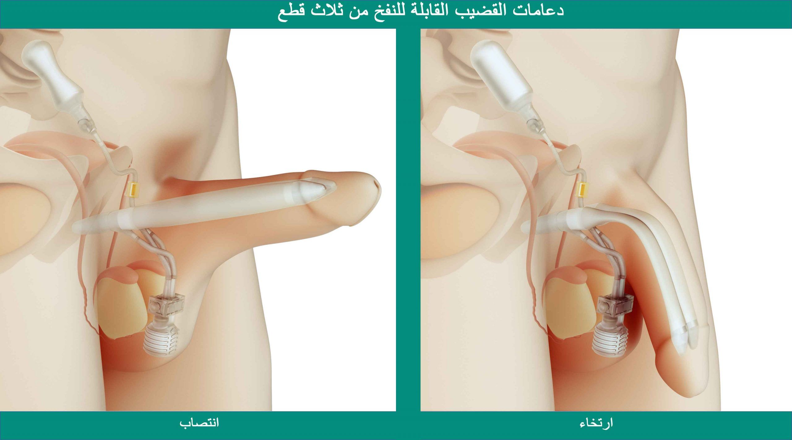 الدعامات المكونة من ثلاث قطع قابلة للنفخ: