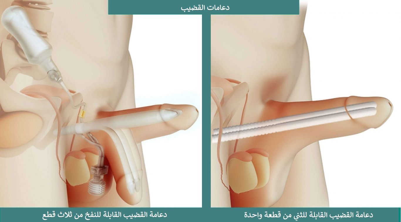 كيف تتم عملية زراعة الدعامات؟