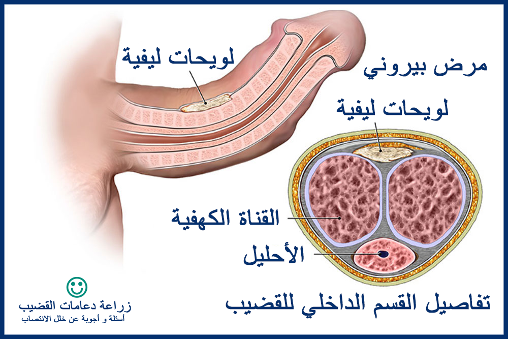 ما هي المشاكل الشائعة في مرض بيروني؟